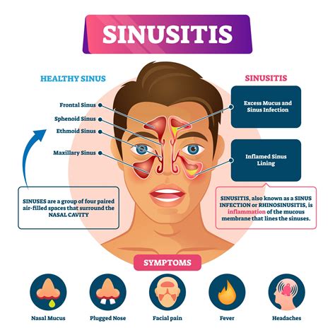 Prevensi Sinusitis